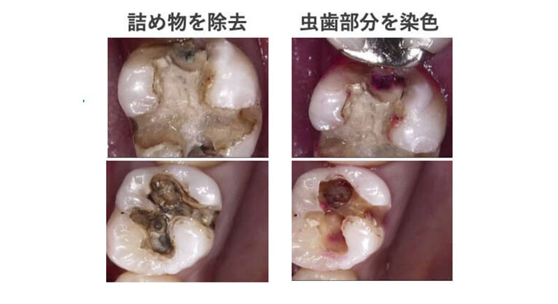 詰め物を外すと…