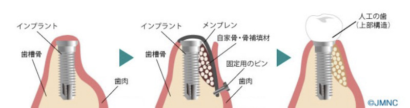 骨が足りない場合の追加の手術（GBR）