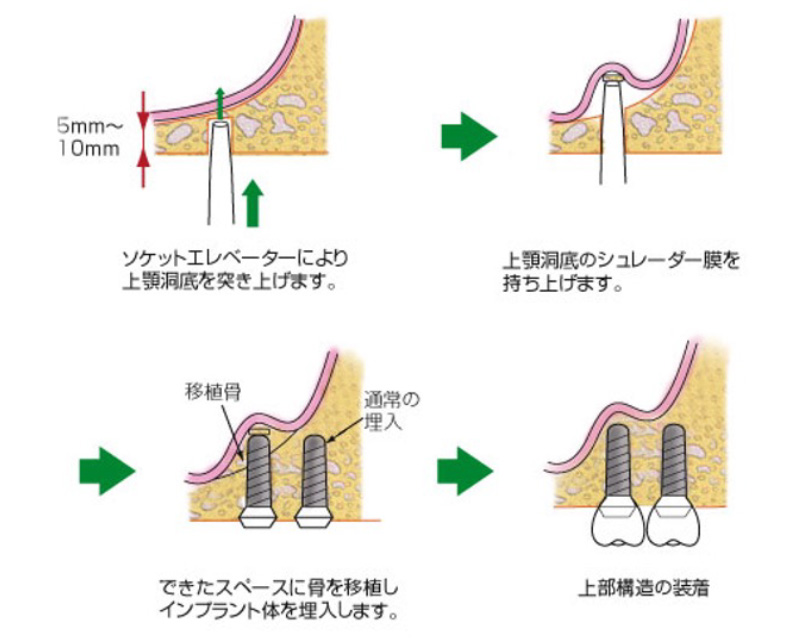 骨が足りない場合の追加の手術（ソケットリフト）