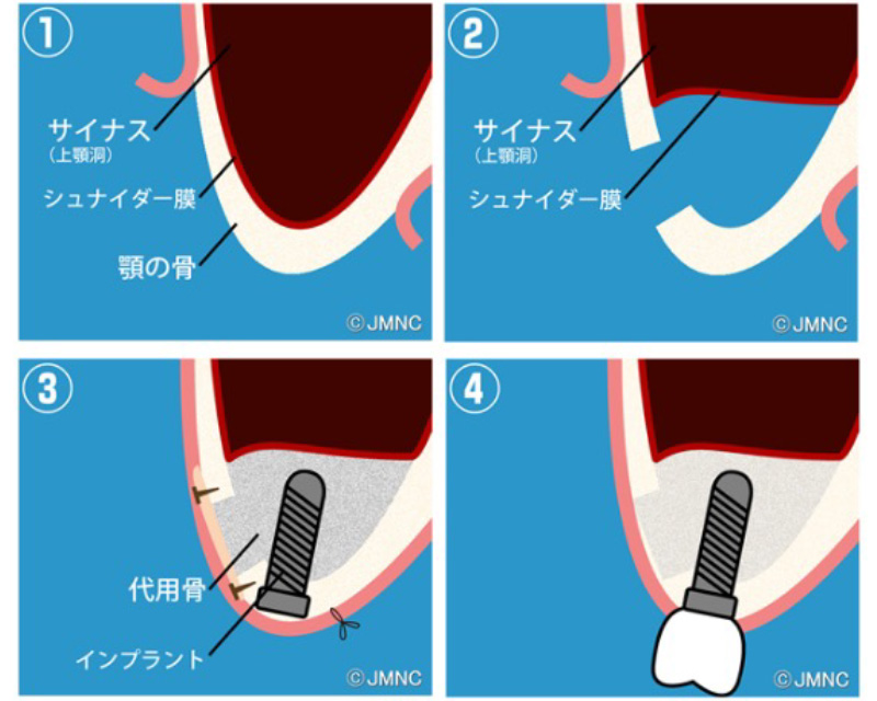 骨が足りない場合の追加の手術（ソケットリフト）