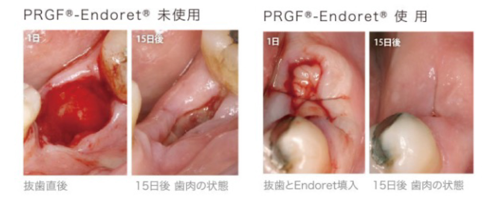 再生医療PRGF