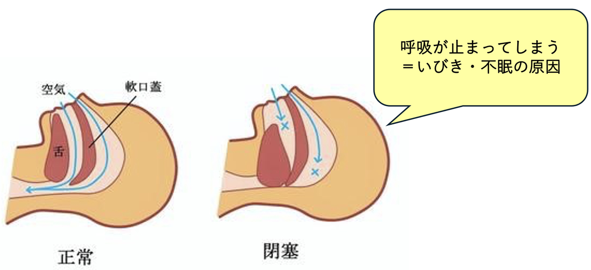 いびき治療外来