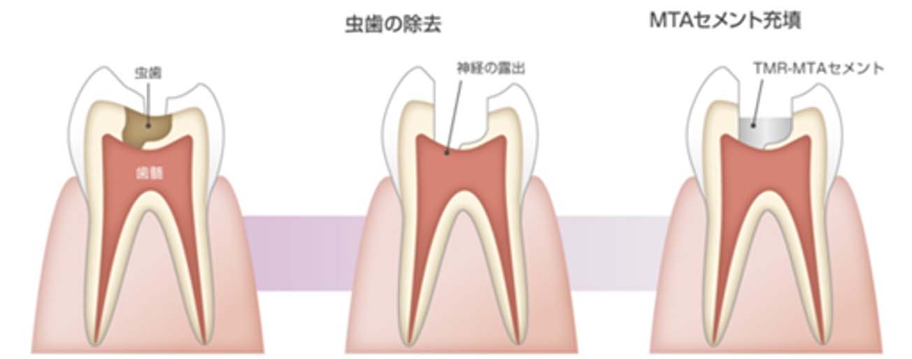 VPT(歯髄温存療法)